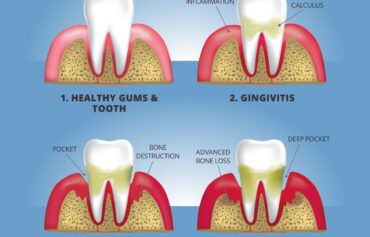 Gum Disease
