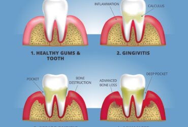 Gum Disease