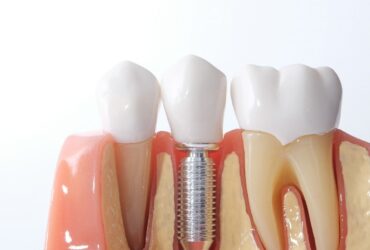 Implantology
